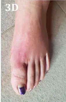 Psoriasis of the Hands and Feet