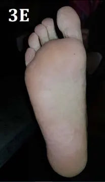 Psoriasis of the Hands and Feet