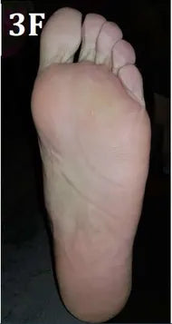 Psoriasis of the Hands and Feet