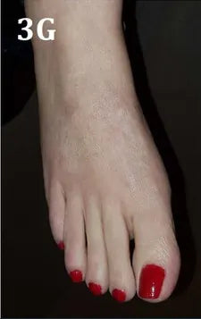 Psoriasis of the Hands and Feet