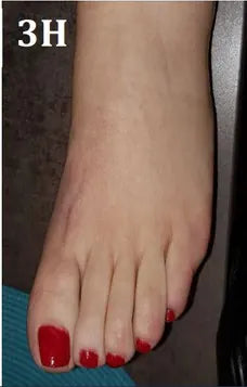 Psoriasis of the Hands and Feet