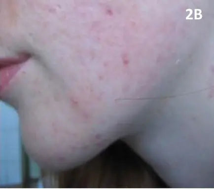 Red Pimples, Marks and Scars