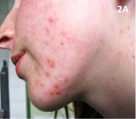 Red Pimples, Marks and Scars