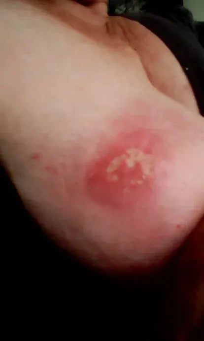 Severe Horse Bite to Breast