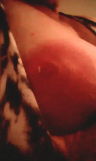 Severe Horse Bite to Breast