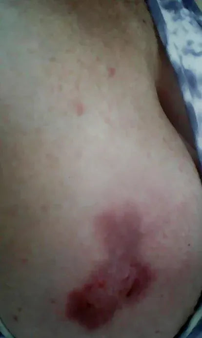 Severe Horse Bite to Breast