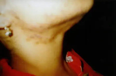 Third-Degree Acne: 3-Week Photo Comparison