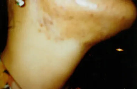 Third-Degree Acne: 3-Week Photo Comparison