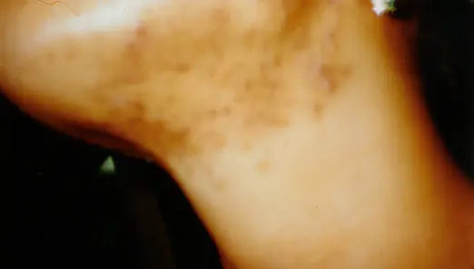 Third-Degree Acne: 3-Week Photo Comparison