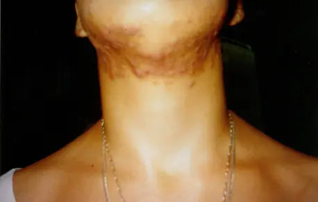 Third-Degree Acne: 3-Week Photo Comparison
