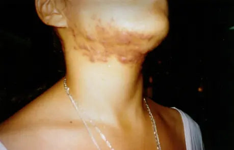 Third-Degree Acne: 3-Week Photo Comparison