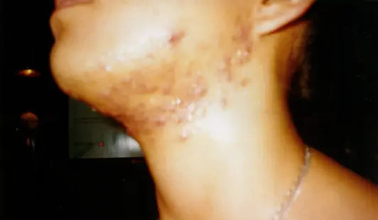 Third-Degree Acne: 3-Week Photo Comparison