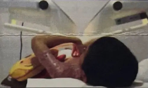 Third-Degree Burns: Singapore Case Report