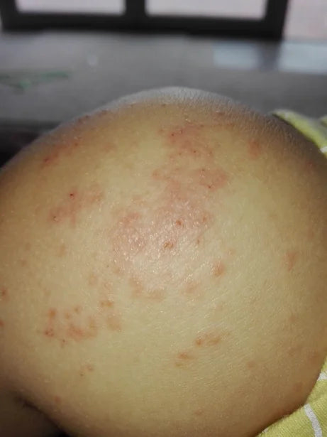 Toddler Eczema After Chicken Pox