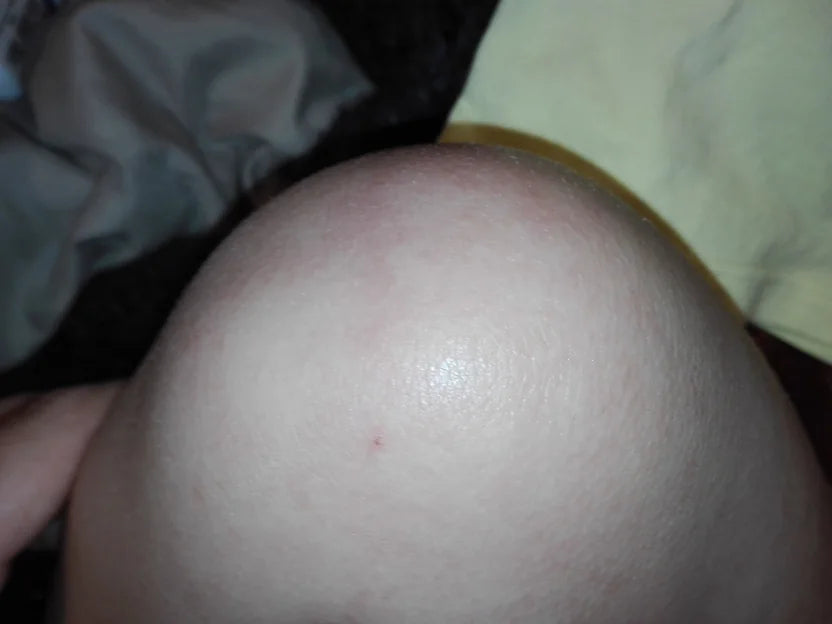 Toddler Eczema After Chicken Pox