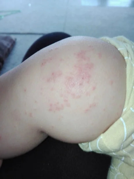 Toddler Eczema After Chicken Pox