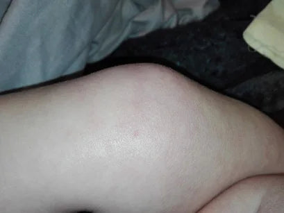 Toddler Eczema After Chicken Pox