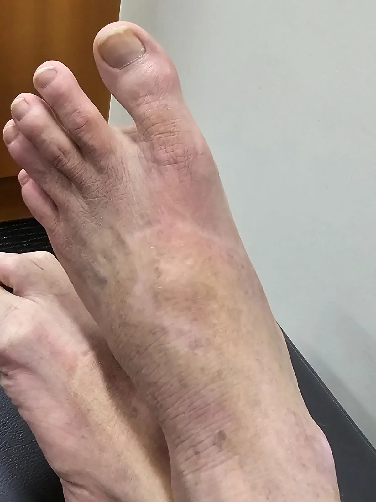 Vanessa’s Arm, Foot and Scalp Skin Photo Series