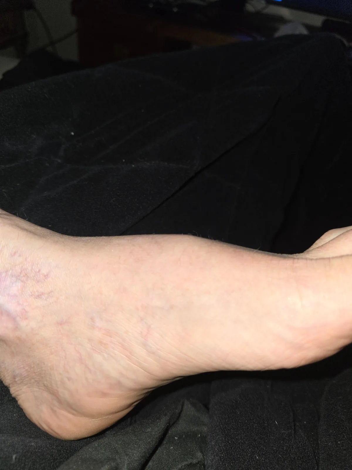 Vanessa’s Arm, Foot and Scalp Skin Photo Series