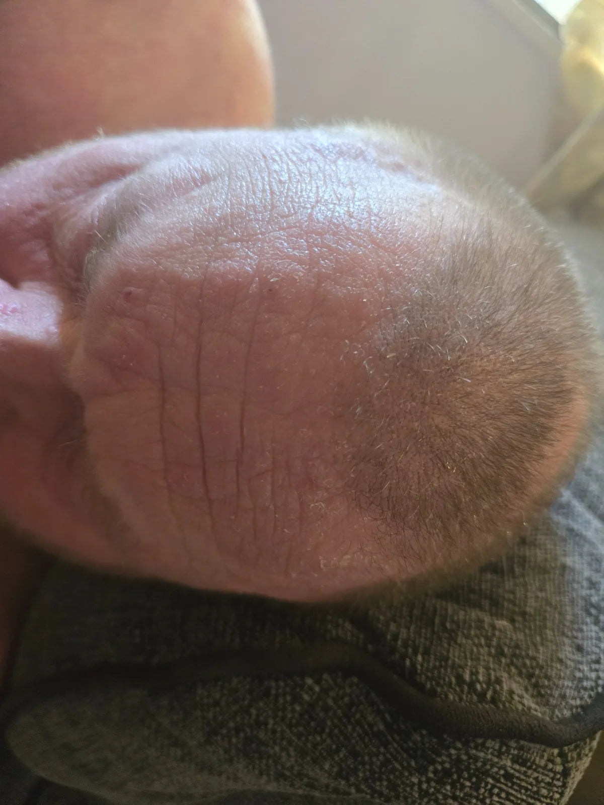 Vanessa’s Arm, Foot and Scalp Skin Photo Series