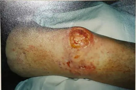 Zelda: Deep Burn and Melanoma Surgery Scar