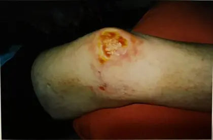 Zelda: Deep Burn and Melanoma Surgery Scar