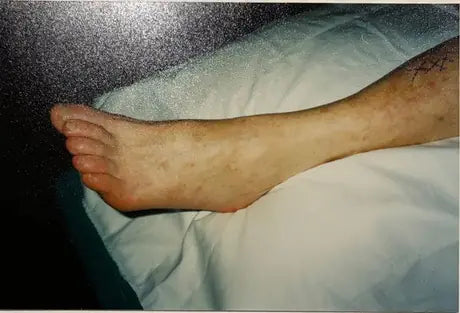 Zelda: Deep Burn and Melanoma Surgery Scar