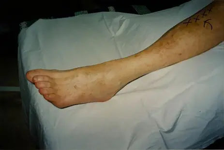 Zelda: Deep Burn and Melanoma Surgery Scar